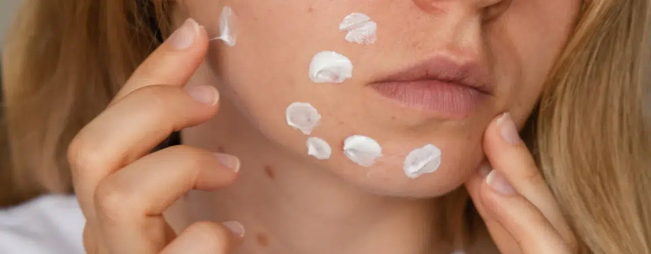 acne scar care