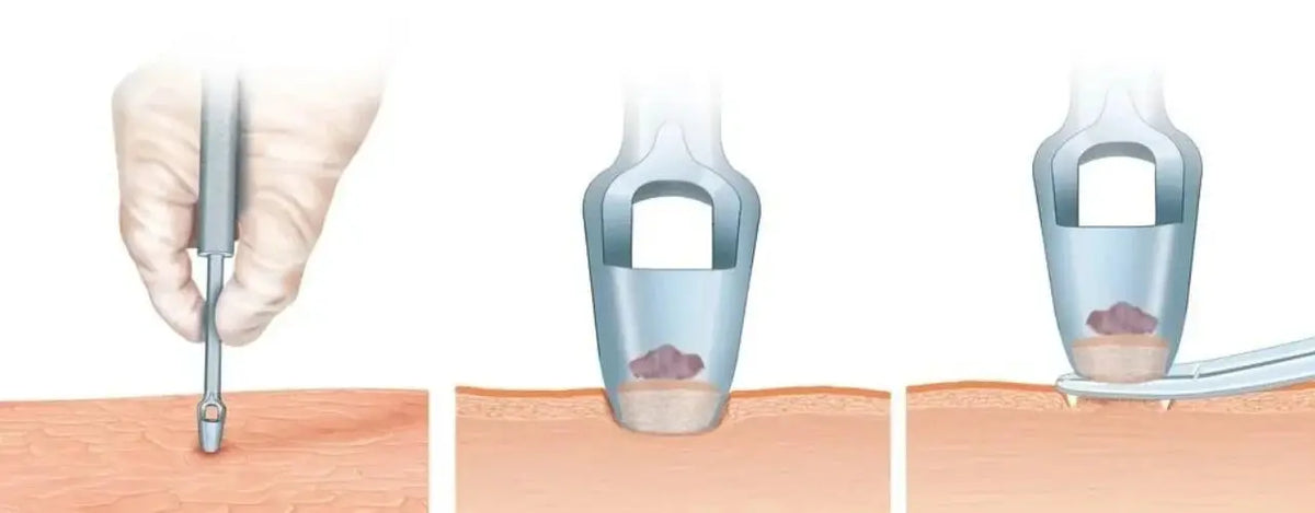 Punch Skin Biopsy: Quick and Precise Diagnosis for Skin Concerns