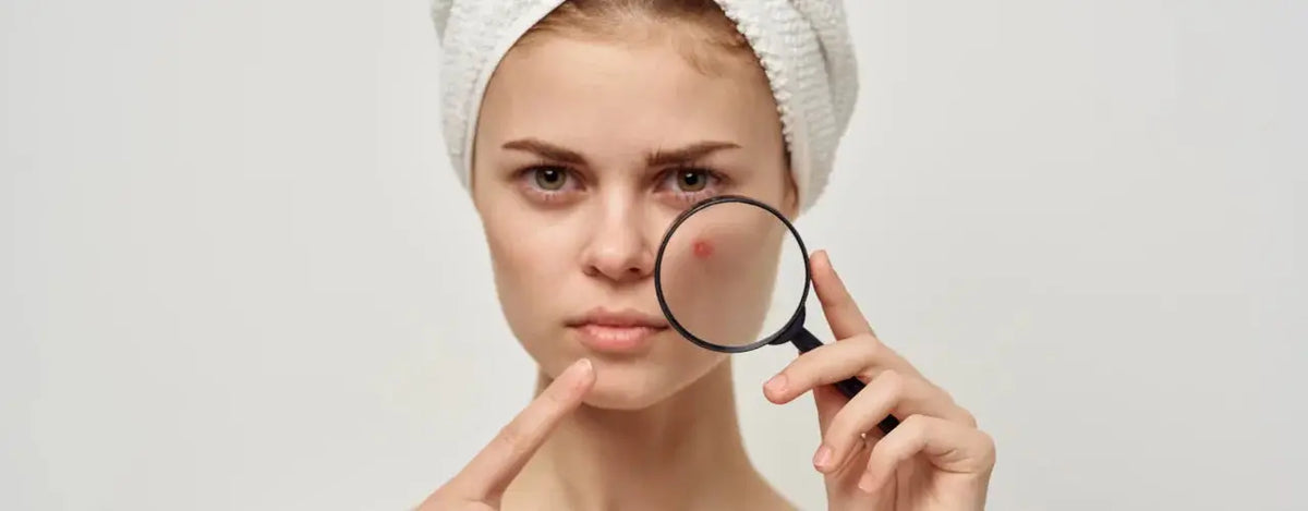 Pimples, Papules, Pustules: A Deep Dive into the World of Acne