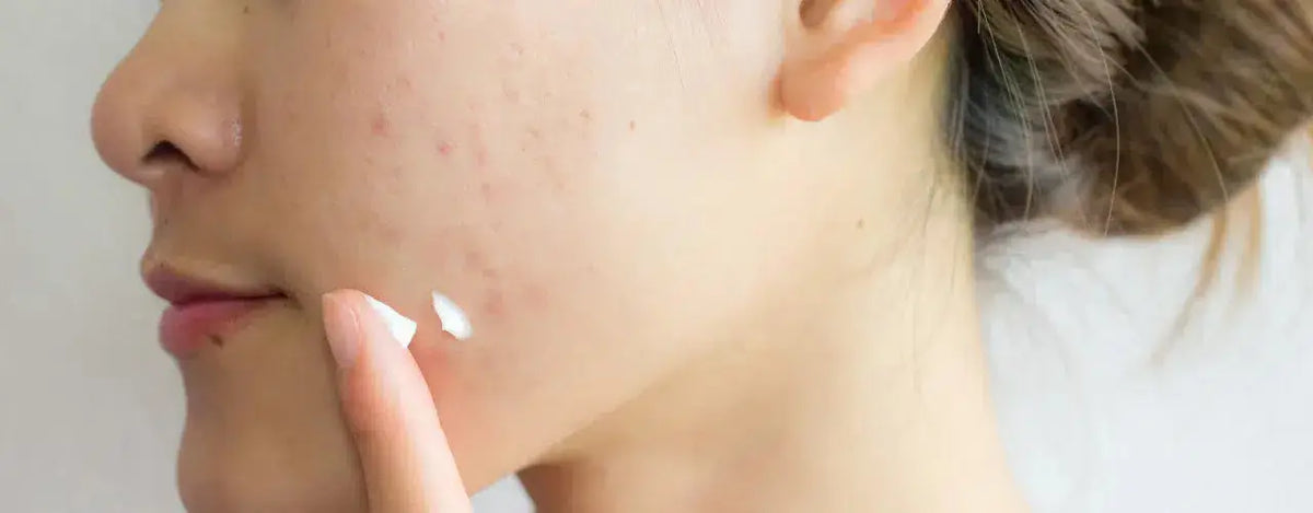 ACNEWIPE Acne Clarifying Gel: A Natural Solution for Rapid Acne Treatment