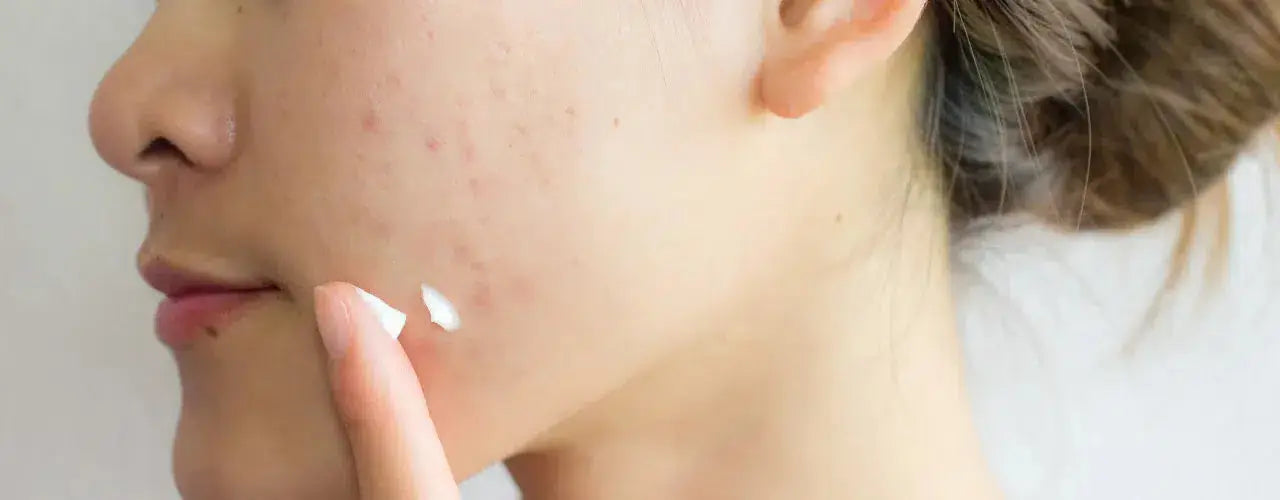 acne gel