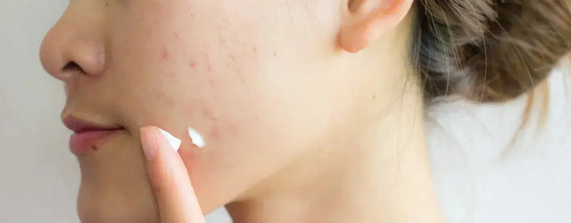 ACNEWIPE Acne Clarifying Gel: A Natural Solution for Rapid Acne Treatment