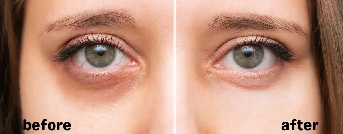 Melona-l Eye Roller: Complete Eye Contour Care for Dark Circles, Puffiness, and Eye Bags
