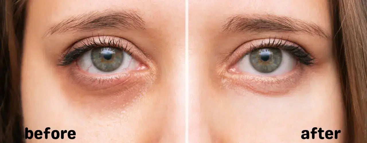 Dark Circles