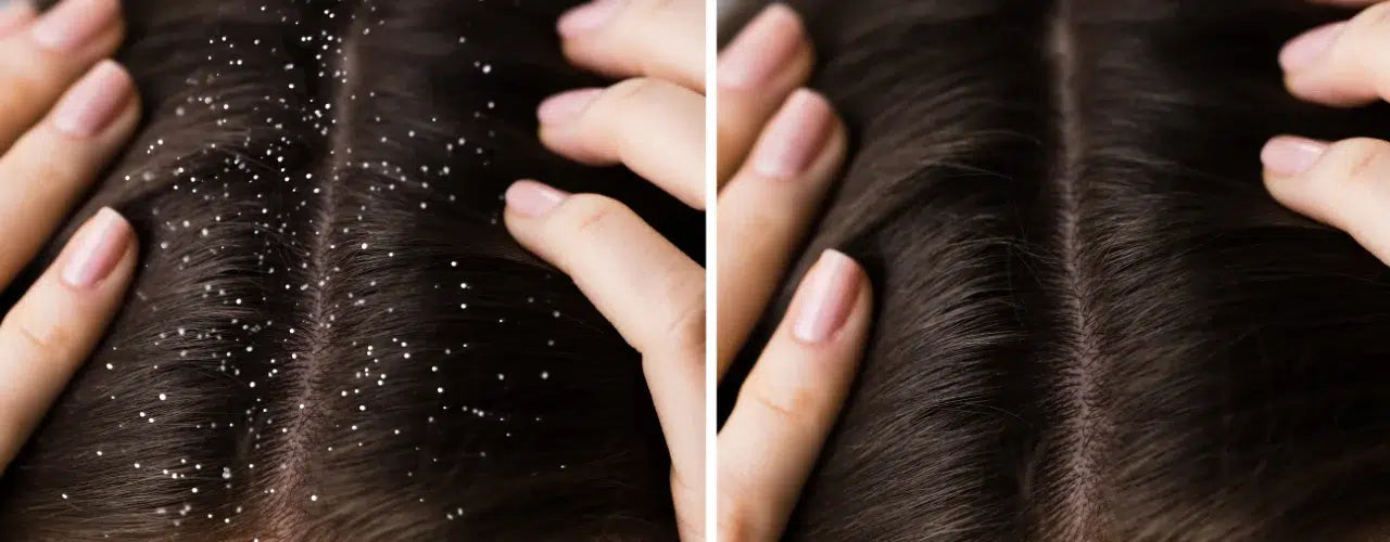 HAIR DANDRUFF-M