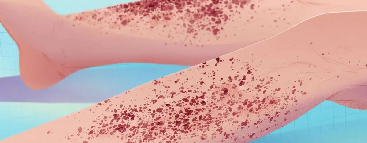 Cutaneous Vasculitis: Understanding Reddened Skin Bumps and Beyond