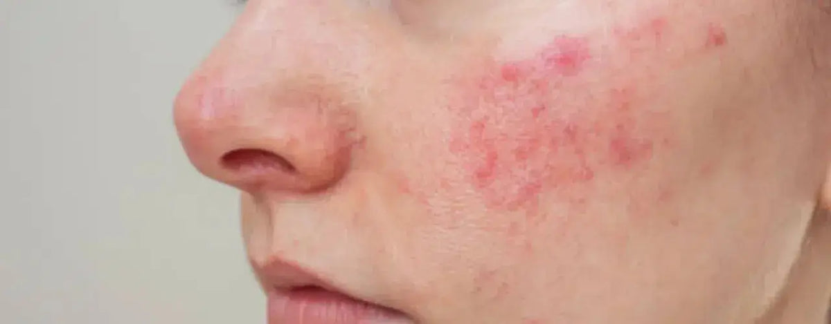 Psoriasis Relief is Possible: Mystery of Chronically Flaky Skin