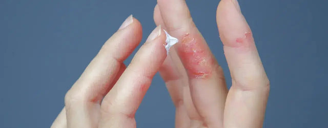 Onvate Lotion: Your Topical Solution for Atopic Dermatitis Relief