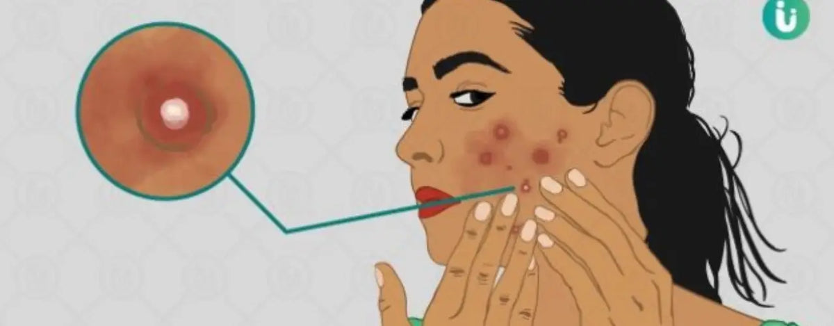 Pemphigus Vulgaris: Hope Beyond Blisters