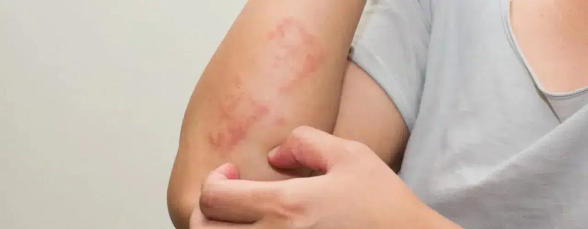 Don't Scratch That! The Itch of Lichen Planus