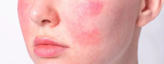 Living with Rosacea: A Guide to Managing the Chronic Facial Skin Condition