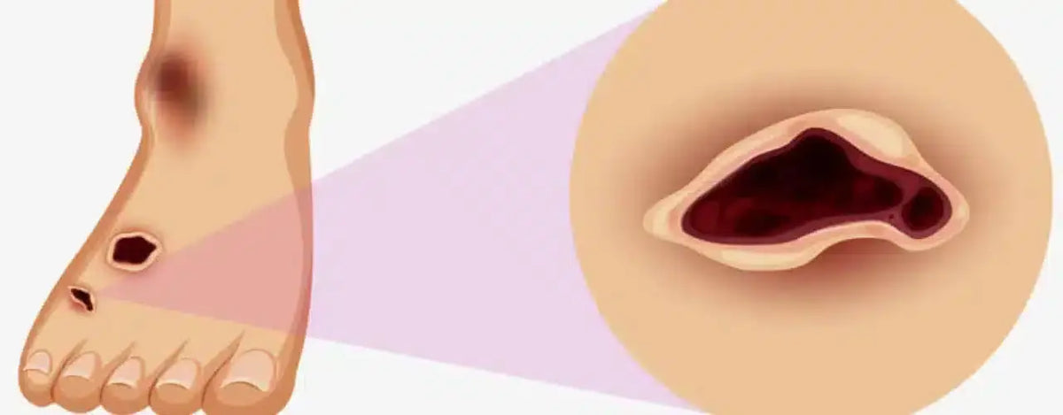 Leg ulcers: Understand Your Vulnerability and Take Control