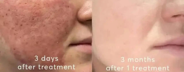 Post Treatment Care Of Fractional CO2 Laser For Acne scars