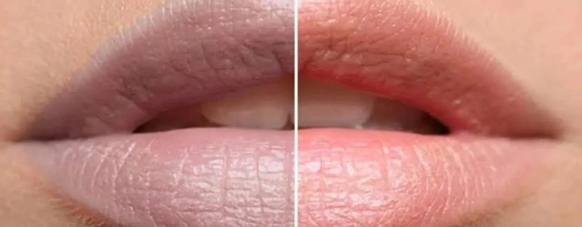 Dark and Pigmented Lips: Role Of Pico Laser