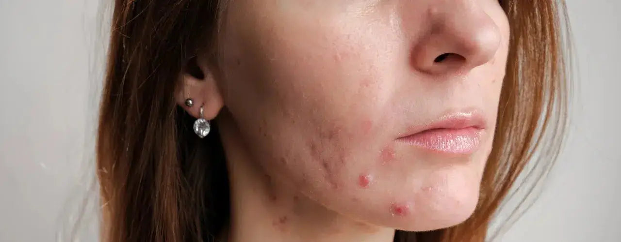 acne