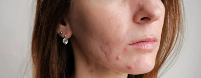 Simple Tips for Managing Acne Naturally