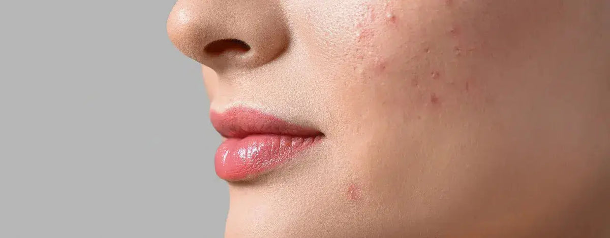 Maz Clarity Anti-Acne Cream: A Powerful Solution for Clearer, Blemish-Free Skin