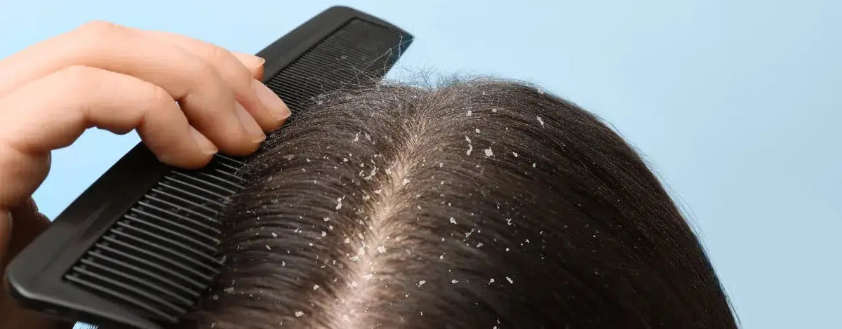 DELIC SHAMPOO: Your Solution for Dandruff and Scalp Health