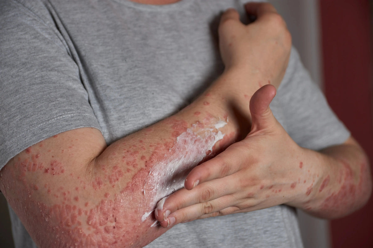 1% Ivermite Lotion for Scabies & Lice Treatment: Buy Online in Pakistan