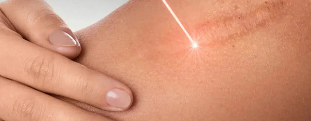 Beyond Steroids and Surgery: Fractional CO2 Laser for Keloids