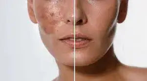 Best Acid for Hyperpigmentation