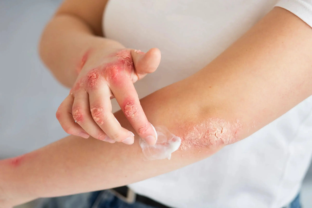 What Is Hydrozole Cream Used For? Benefits Explained