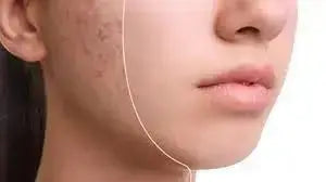 Pimple Scar Removal: 7 Effective Methods to Restore Clear Skin