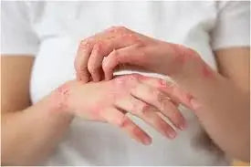 Lotion for Scabies Treatment – Fast Relief &amp; Itch Control