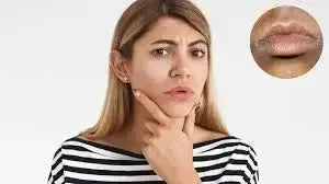 Hyperpigmentation Around Mouth: Causes and Effective Treatments