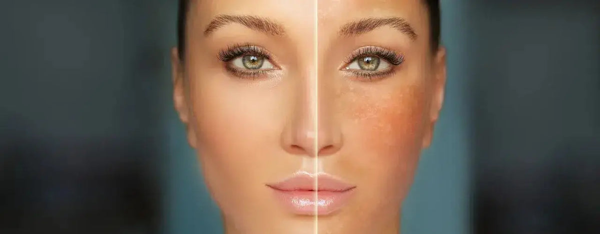 BioRePeel for Melasma: Emerging Treatment Option