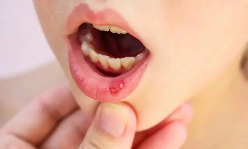 Kenalog in Orabase in Pakistan: Oral Ulcer &amp; Mouth Sore Relief