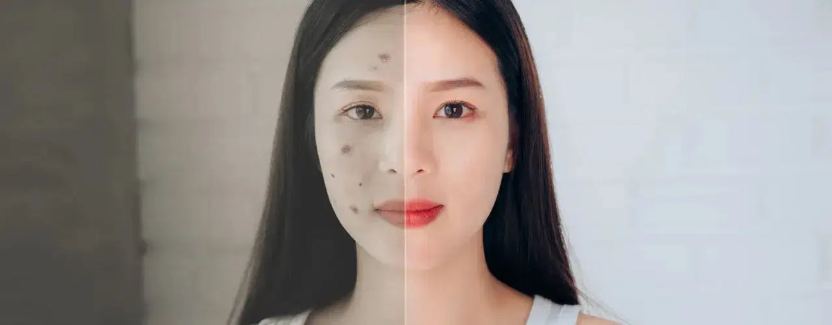 ACNI SOL Face Wash: Your Ultimate Solution for Acne-Free, Healthy Skin
