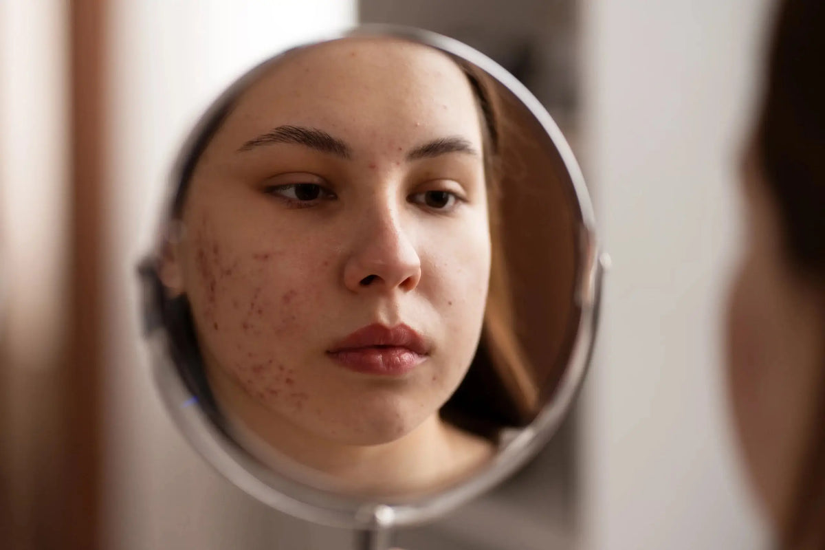Arynoin Plus Gel Uses: Acne Treatment Benefits