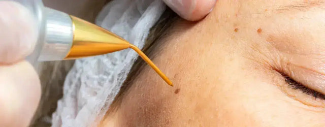Wart Treatment: Your Solution for Wart, Corn, and Callus Treatment