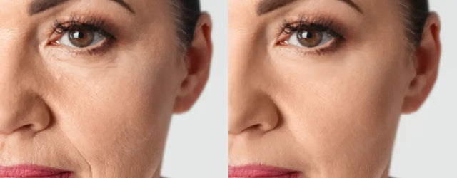Say Goodbye to Melasma with Cute-E Cream Advanced Formula