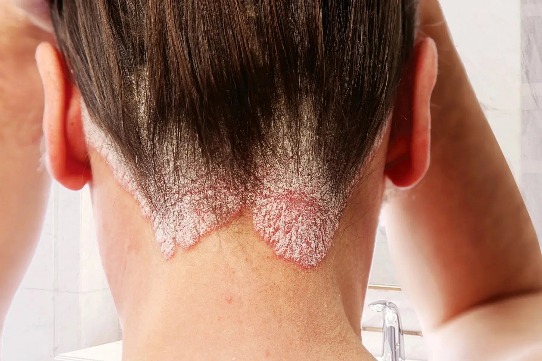Psoriasis Derma.pk