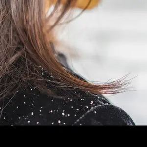 Anti Dandruff