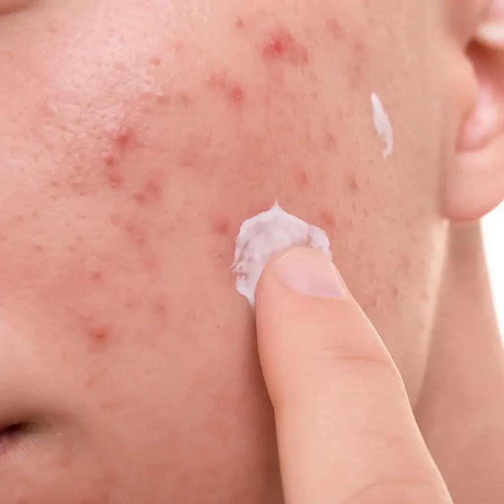 Topical antibacterial
