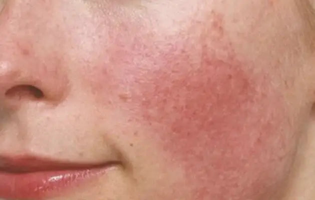 Redness on face