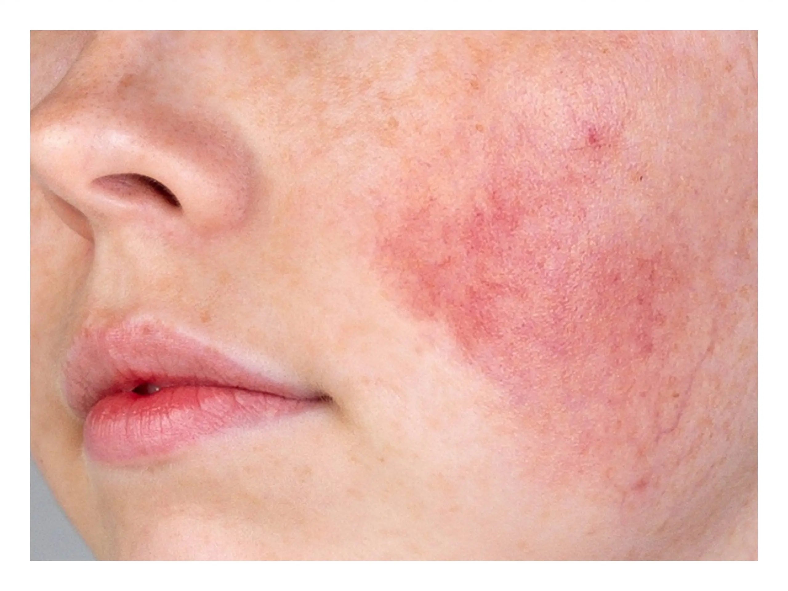 Sensitive skin 