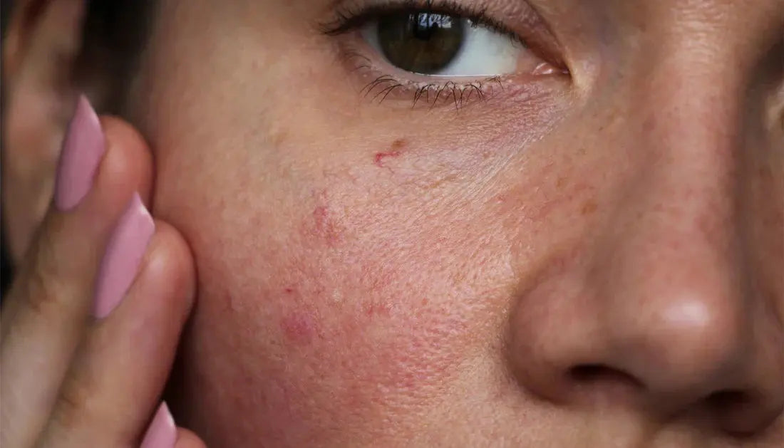 For-Sensitive-Redness-Prone-Skin Derma.pk