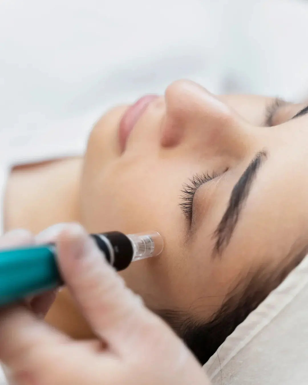 Microneedling