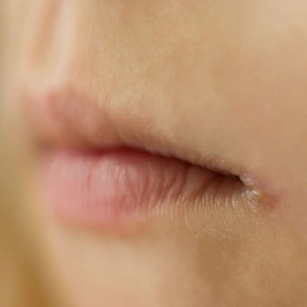 Angular-Cheilitis Derma.pk