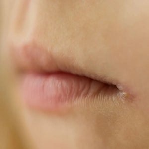 Angular Cheilitis