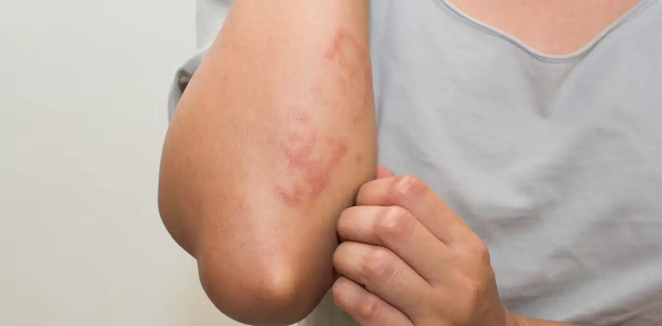 Rash