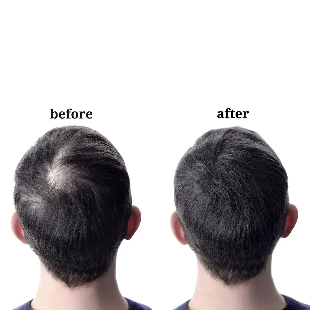 Finasteride Derma.pk