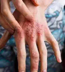 Eczema treatment creams and moisturizers in Pakistan | Derma.pk