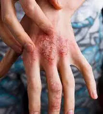 Eczema treatment creams and moisturizers in Pakistan | Derma.pk