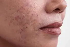 Hyperpigmentation Derma.pk