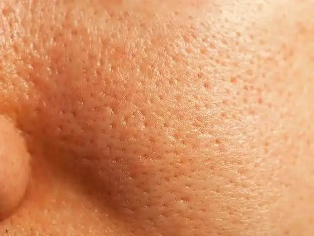Open pores 